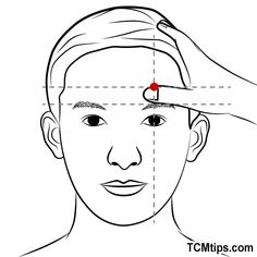 the Touwei or ST-8. This is another stomach meridian Migraine Pressure Points, Acupuncture Points Chart, Acupuncture Needle, Brain Stimulation, Migraine Headaches