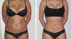 Vaser Lipo, Lipo Before And After, Mommy Makeover Surgery, Smart Lipo, Laser Lipo, Mommy Makeover, Detox Plan, Cool Sculpting, Compression Garment