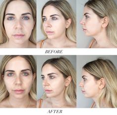 Looking youthful: My experience with cheek fillers! - A Pop of Colour Cheek And Chin Fillers Before After, Filler In Cheeks Before And After, Cheek Fillers Before And After, Before And After Cheek Filler, Dermal Fillers Before And After, Cheek Filler Before And After, Cheekbone Filler Before And After, Fillers Before And After, Chin Filler