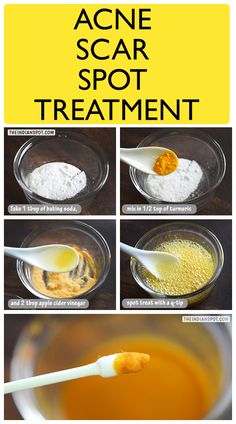 Scar treatment, dark spot fader, baking soda face mask, diy skincare Face Mask Diy Skincare, Laser Acne Scar Removal, Baking Soda Face Mask, Acne Laser, Face Mask Diy, Healthy Soda, Baking Soda Face, Brown Spots On Face, Acne Scar