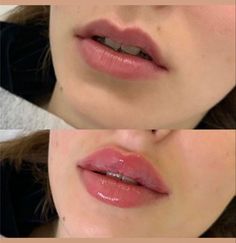 Angelina Jolie Lips, Face Plastic Surgery, Beauty Tips For Glowing Skin, Full Lips, Cosmetic Treatments, Perfect Lips, Cosmetic Procedures