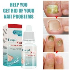 Stay away from the gray nails, make your nails more healthy and beautiful! Here is a detailed guide to nail care for all your intermediate nail care needs! Description:Nail Care Solution, Nail And Toe Care Solution, For Skin Care Nail Nourishing, Fungal Nail Liquid 10ml Nail Care Solution, Nail And Toe Care Solution, For Skin Care Nail Nourishing, Fungal Nail Liquid 10ml Product Description Powerful-This solution solve fungi with a maximum strength that can penetrate the skin while retaining moi