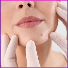 When it comes to Mole Removal Treatment in Dubai, choosing the right option can be crucial. Moles, though often harmless, can sometimes be a cause for concern, especially if they change in size, shape, or color. In such cases, seeking professional advice is essential to determine the best course of Red Moles, Face Pores, Sick Remedies, Diy Fashion Projects, Natural Hair Mask, Lip Care Routine, Women Health Care