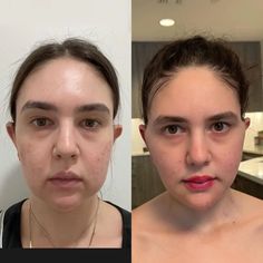 two women with acne on their faces and one woman without her shirt is looking at the camera