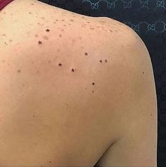 the back of a woman's body with acne and spots on her skin