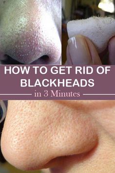 Not every woman spend a lot of money and time to look beautiful. There are always hacks or tips that you can use to help you to look like you spend hours Rid Of Blackheads, Get Rid Of Blackheads, Girl Tips, Blackhead Remover, Belleza Natural, Simple Tricks, Aging Skin, Blackheads, Beauty Secrets