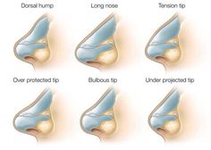 Types of nose anatomy Pimple Inside Nose, Acne On Nose, Anatomy Head, Nose Surgery Rhinoplasty, Nose Types, Rhinoplasty Nose Jobs, Nose Reshaping, Rhinoplasty Surgery, Pretty Nose