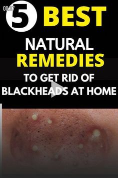 Getting Rid Of Blackheads, Nose Picking, To Remove Blackheads, Rid Of Blackheads, Pimples Remedies, Lower Back Pain Exercises