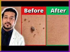 How to Remove Skin Tag in 1 Night – Koperacija The skin tag is the small growth of the skin which is usually around the neck, eyes, and underarms. Likewise, it is not necessary to visit the doctor for... Warts Remedy, Face Pores, Healthy Life Hacks, Skin Face Mask, Dark Spots On Face, Natural Skin Care Remedies