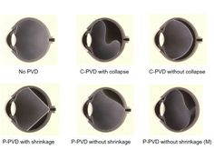 Retina Detachment, Vitreous Detachment, Posterior Vitreous Detachment, Optometry Education, Human Skeletal System, Optometry School, Medical Ultrasound, Medical Library, Eye Facts