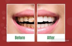 ProDentim Reviews (Urgent Customer Warning!) Safe Candy or Waste of Money? | Healthy teeth, Sensitive teeth, Dental care #Grills_Teeth #Stronger_Teeth #Tooth_Sensitivity #How_To_Prevent_Cavities