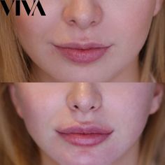 Natural results are our thing, incase you didn’t already know 😉 Our top tip for natural looking results is starting off small with 0.5ml and then adding to it if need be… Small Lips Filler, Lip Filler Inspiration 0.5ml, Small Lip Filler, Natural Lip Fillers Small Lips, 0.5 Lip Filler, 0 5 Ml Lip Filler, Lip Filler 0.5ml, 0.5 Lip Filler Before And After, Natural Lip Fillers 0.5ml