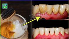 How To Remove Plaque And Tartar From Your Teeth Without A DentistBillions of dollars are spent annually to whiten and bleach teeth with lasers, whitening str... Natural Plaque Remover At Home, Clean Teeth Plaque How To Remove, Teeth Plaque Removal At Home, Removing Plaque From Teeth At Home, How To Get Rid Of Plaque On Teeth, How To Clean Teeth At Home, How To Remove Plaque From Teeth At Home, How To Brush Your Teeth, Turmeric For Teeth