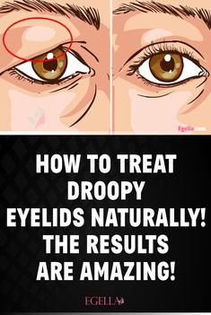 Eyelid Wrinkles, Anti Wrinkle Face Mask, Sagging Eyelids, Droopy Eyelids, Wrinkle Remedies, Healing Remedies, Natural Healing Remedies