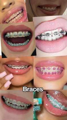 Braces Perfect Teeth Braces, Braces Aesthetic, Pink Braces, Braces Smile, Teeth Aesthetic, Types Of Braces, Pretty Teeth