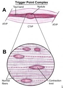 How many muscle knots (trigger points) do you have? Did you know that massage… Neuromuscular Therapy, Tension Release, Muscle Knots, Massage Therapy Techniques, Craniosacral Therapy, Dry Needling