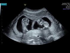 Twin Ultrasound, Twin Baby Boys, Baby Twins, Ulzzang Kids