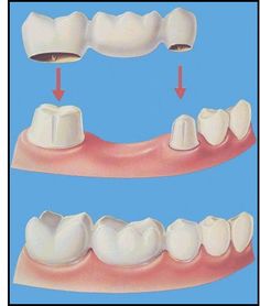 Dental Bridge Cost, Dental Posters, Dental Aesthetics, Dental Facts, Dental Life, Teeth Implants, Dental Bridge, Dental Crowns, Dental Humor