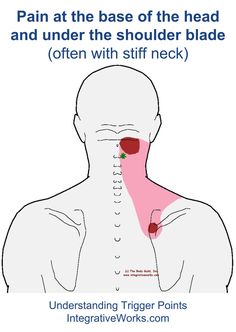 Years of clinical experience reveal that pain under the shoulder-blade with neck pain are usually caused by two or three other patterns. The pain under the shoulder is most commonly this trigger po… Punkty Spustowe, Excellent Health, Stiff Neck, Upper Back Pain, Neck And Shoulder Pain, Headache Relief, Trigger Points, Shoulder Pain