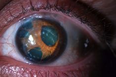 Eye with polycoria (multiple pupils) - Imgur Credit: Biomancer Multiple Pupils, Hair Whorl, Eyes Aesthetic, Human Oddities, Dark Cottagecore, Unusual Things, Human Eye, Cottagecore Aesthetic, Human Condition