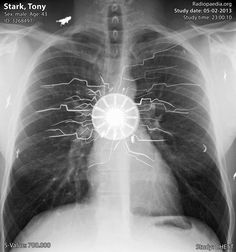 an x - ray image shows the chest and lungs, which are visible in black and white