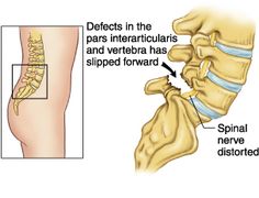 Spondylolisthesis - in my case, the L5 vertebra has slipped forward over the S1, pinching the spinal nerve (causing sciatica). Note that the bony pars ring is actually broken; spondy is sometimes called a "broken back." I also have scoliosis. Yay for yoga, which is a huge help in managing all this! Severe Back Pain, Spinal Fusion, Spinal Nerve, Pinched Nerve, Spine Health, Sciatica Pain, Leg Pain, Nerve Pain, Sciatica