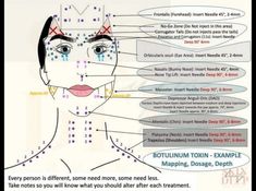 Face Injections, Botox Injection Sites, Facial Injections, Permanente Make-up, Botox Lips, Aesthetic Dermatology, Botox Cosmetic, Botulinum Toxin, Botox Face