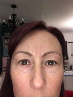 2 weeks after microblading. Faded quite a lot but this does not change the ugly shape of them. I am still using a paste of hydrogen peroxide, lemon juice, baking soda and salt to scrub them daily’s they have peeled and I have a couple of scans on the really awful left brow which is the worst and about 3mm lower than my brow line! My top up treatment is in about 6 weeks but there is no way that woman is going to draw on my face like a toddler again! Eyebrow Fails, Hydrogen Peroxide, Lemon Juice