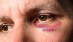 7 BEST HOME REMEDIES FOR BLACK EYES We refer to an eye bruise as a black eye. When blood collects behind the skin around the eyes, it occurs. Black eyes typically form after a head or face injury, however, they can also appear following facial surgery. https://elnodiacademy.com/black-eye/ Black Eye Injury Reference, Face Bruising, Fake Bruising, Gretchen Costume, Micah Bell, Overnight Remedies, Eye Injury, Head Wound