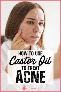 Acne is such a pain in your you-know-what. Fret not, as I would suggest you to consider using castor oil for acne. Here is how to use it & everything about Castor Oil For Acne, Forehead Acne, Skincare Acne, Acne Face Mask, Acne Skincare, Natural Acne Remedies, Acne Oil, Skin Cleanser, How To Get Rid Of Pimples