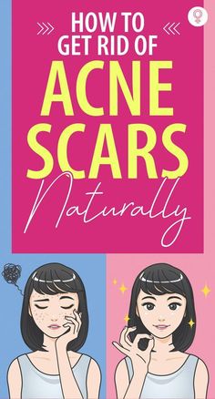 Natural remedies are an effective alternative to surgery or harsh techniques for treating acne scars. These 12 remedies can help lighten your scars gently. Pimple Marks Removal Homemade, Hard Pimple, Acne Scaring, Home Remedies For Pimples, Forehead Acne