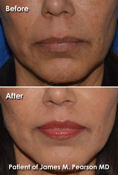 Lip Lift by Dr. James Pearson Facial Plastic Surgery Double Chin Surgery, Kylie Jenner Plastic Surgery, Lip Implants, Tighten Neck Skin, Botox Brow Lift, Chin Implant, Nose Reshaping, Jaw Surgery