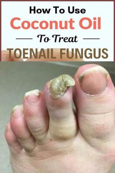 Toenail fungus gone in one week! - Nail Fungus Cause By Shoes You Can Easily Wipe By Doing THIS by Clementine Skyler | This newsletter was created with Smore, an online tool for creating beautiful newsletters for educators, businesses and more Nail Remedies, Choppy Hairstyles, Shaggy Bob