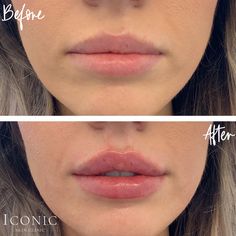 Subtle Lip Filler Before And After, Lips Goals, Lip Filler Shape Ideas, Lip Fillers Juvederm, Aesthetic Medical, Lips Inspiration