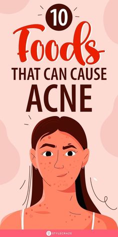 10 Foods That Can Cause Acne Good Face Wash For Acne Clear Skin, Bad Acne Pictures, Good Skin Tips Acne, Causes Of Pimples, Pimple Remedies, Bump Progression, Remedy For Acne, Food For Acne, Acne Causing Foods