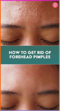 Forehead acne is a condition that affects many men and women worldwide. Learn about its causes, treatment options, and how to prevent it from coming back. Forehead Pimples, Get Rid Of Forehead Acne, Forehead Bumps, Pimples On Forehead, Blind Pimple, Forehead Acne, Pimples Under The Skin, Bad Acne, Get Rid Of Pimples