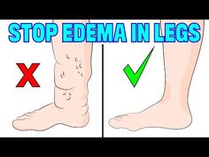 How to naturally reverse edema swelling in your legs - YouTube