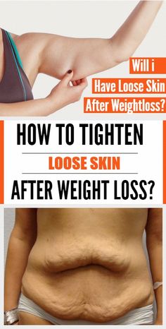 How to tighten loose skin after weight loss | for you miss #BestExerciseForSaggyStomach #LumpUnderSkinOnBack #LumpBelowSkin Tighten Stomach, Skin Tightening Stomach, Tighten Loose Skin, Skin Bumps, Saggy Skin, Loose Skin, Sagging Skin, Mediterranean Diet, Skin Tightening