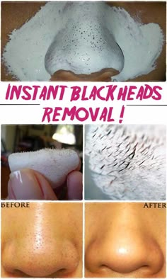 Obličejové Masky, Aesthetic Health, Hacks Every Girl Should Know, Blackhead Removal, Remove Blackheads, Get Rid Of Blackheads, Beauty Remedies, Homemade Beauty Products, Blackhead Remover