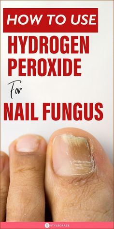 In this article, we share a step-by-step guide of how to use hydrogen peroxide for nail fungus. Learn how it works along with some safety and precautionary tips. Nails Remedies, Toe Nail Fungal Infection, Toenail Fungal Infection, Nail Remedies, Toenail Fungus Remedies, Nail Fungus Remedy, Nails Healthy, Nail Infection, Fungal Nail