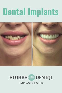 Before and after the All-on-4 fixed hybrid denture procedure. If you are tired of being in pain, hiding your smile, call for your free consultation today. We have the lowest price in Utah! #allonfour #dentalimplants #dentures #oralhealth Dental Procedures