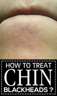 Blackheads on chins can be annoying to deal with. Read to know more about the different causes and home remedies you can use to treat blackheads on your chin. Chin Blackheads, Warts On Face, Get Rid Of Blackheads, Foto Tips, Travel Plan, Skin Pores, Naha, Natural Home Remedies, Blackhead Remover