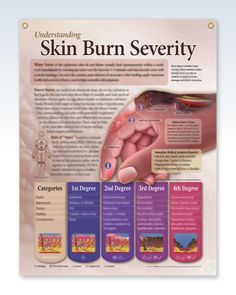 This 20" x 26" (51 x 66 cm) custom printed poster pre­sents digni­fied visual is use­ful when discussing extent of dam­age with burn patients or family members. Few people can endure third-degree burns conering 50 percent of the body. Learn strategies for common emer­gencies. Get this medical poster for derma­tolo­gists doctors’ offices, urgent care hospitals and burn centers. ©2013 More This may be the least expensive insurance you ever purchase. Fire spreads quickly and unexpectedly. What you do within the next few minutes determines severity of burns. A 2nd degree sun­burn can migrate to a 3rd degree burn because of improper care. Scald­ing hot water or a grease fire could throw you in a state of panic leading to months or years of rehabili­ta­tion. Prepared in consultation with UC Irvi Rule Of Nines, Cna School, Nursing School Prerequisites, Anatomy Poster, Severe Burns, Medical Posters, Best Nursing Schools, Skin Burns