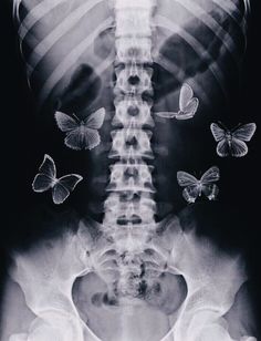 an x - ray shows butterflies flying around the neck