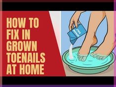 9 Effective Ways To Fix Ingrown Toenails At Home | Health - Fitnesshow to fix an ingrown toenail,how to cure ingrown toenail,what to do for ingrown toenail,h... Natural Remedies For Migraines, Ingrown Toenail, Dry Skin Remedies, February Nails, Home Remedies For Hair, Home Health Remedies, Ingrown Toe Nail, Cold Home Remedies, Women's Fitness Motivation