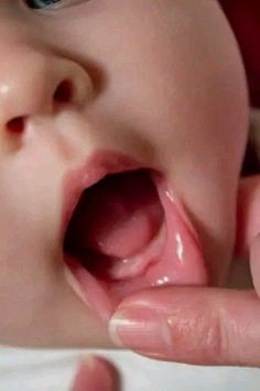 Teething In Babies, Teething Fever, Rash On Face, Smile Tips, Swollen Gum, Dental Student, First Tooth