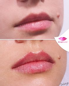 Lip Fillers Juvederm, Lips Inspiration, Beauty Killer, Best Makeup Tutorials, Glossy Eyes, Lip Augmentation, Facial Aesthetics, Lip Filler, Celebrity Plastic Surgery