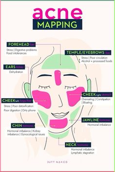 It doesn’t matter if you’re a teen suffering from acne, or an adult suffering from acne related to stress or hormones; it hurts to have acne. I know what it’s like to suffer from acne and not know where to turn to for acne help. So, here are all the effective treatments for acne with some additional skin-care tips to prevent it from ever happening: Acne Map, How To Treat Pimples, Face Map, Different Types Of Acne, Face Mapping Acne, Acne Tips, Acne Help, Face Mapping