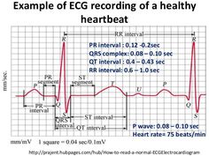 Ecg Interpretation, Pr Interval, Nursing Classes, Student Tips, Nurse Study Notes, Nursing Student Tips, Medical Facts