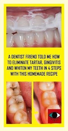 I really needed this! Unprecedented info! Heal Cavities, Teeth Health, Receding Gums, Oral Health Care, Tooth Decay, Healthy Teeth, Oral Hygiene, Oral Care, Cavities